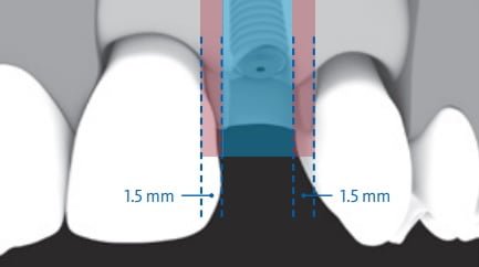 Afbeelding 1 Correct 3D implant position