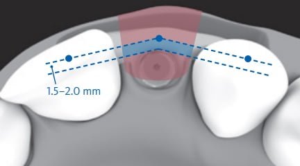Afbeelding 2 Correct 3D implant position