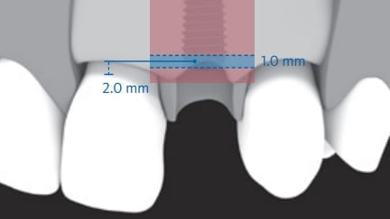 Afbeelding 3 Correct 3D implant position