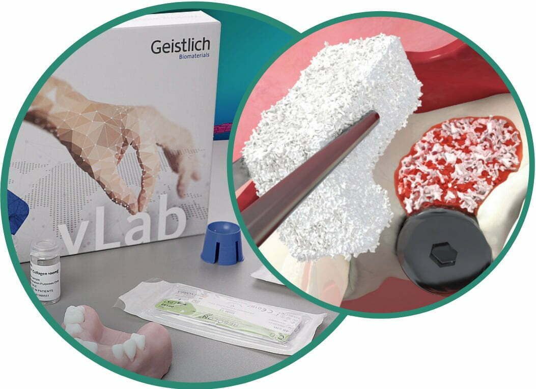 Workshop L-Shape technique | Geistlich+You vLab